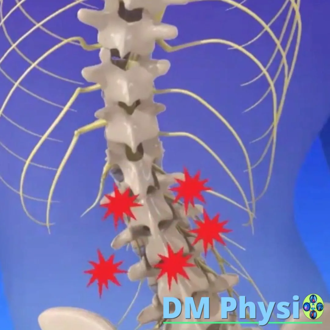 Херниран диск притиска нерв